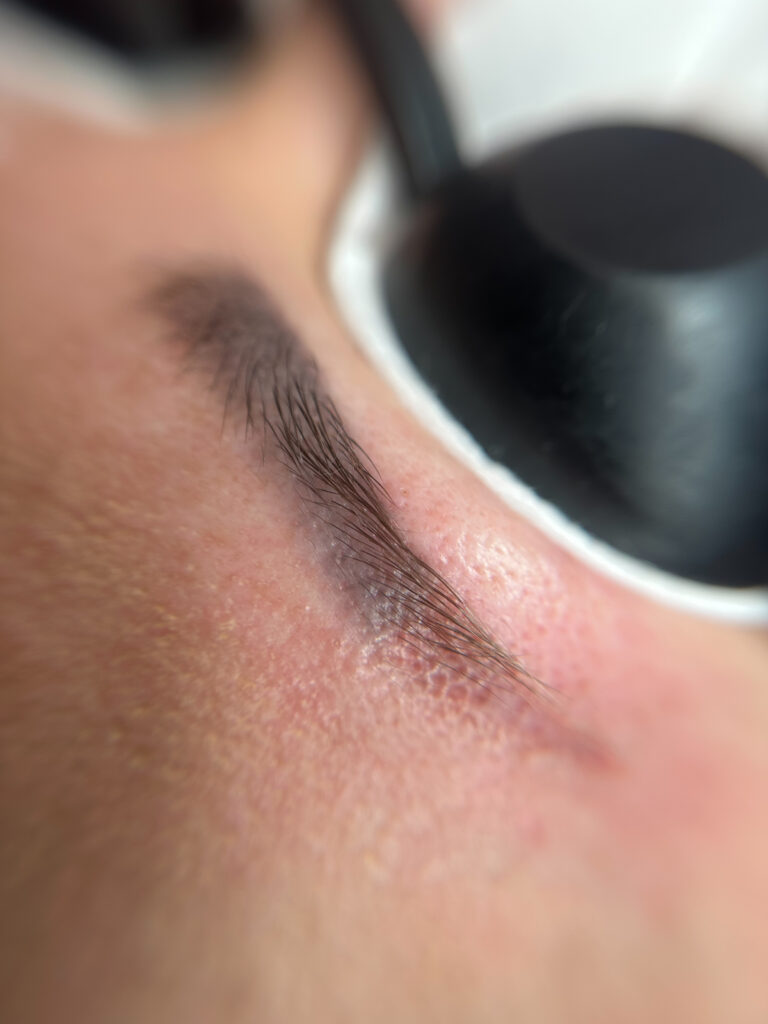 Usuwanie brwi permanentnych w trakcie zabiegu laserem pikosekundowym w Ostrowcu Świętokrzyskim