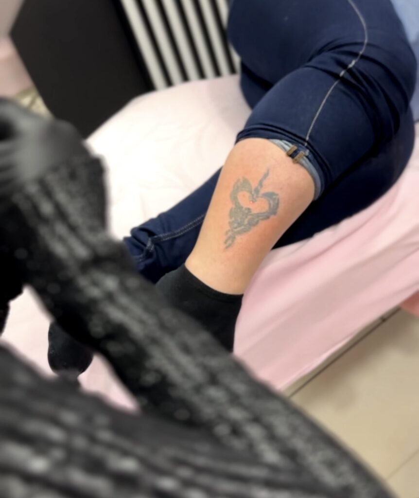 Zabieg laserowego usuwania tatuaży w Ostrowcu Świętokrzyskim